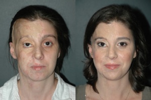 Burn Plastic Surgery Before and After